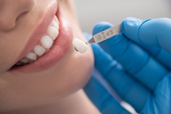 Choosing Between Dental Crowns And Veneers